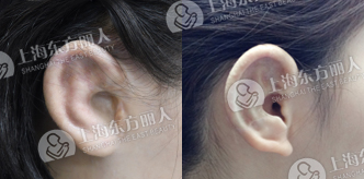 上海耳部整形机构造耳有什么优势