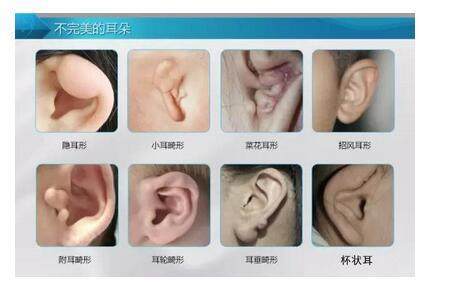 破坏五官和谐美的4种外耳畸形