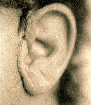 耳再造手术会不会留疤痕吗
