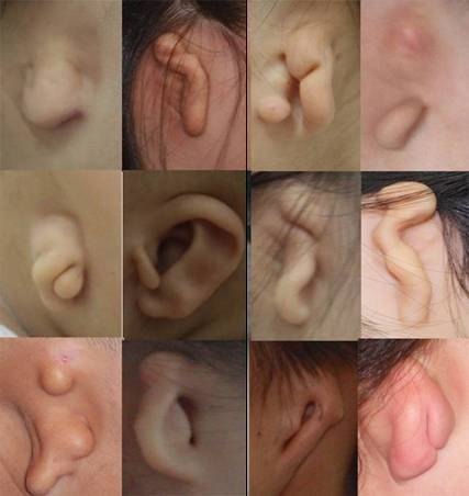 不同形态的耳畸形