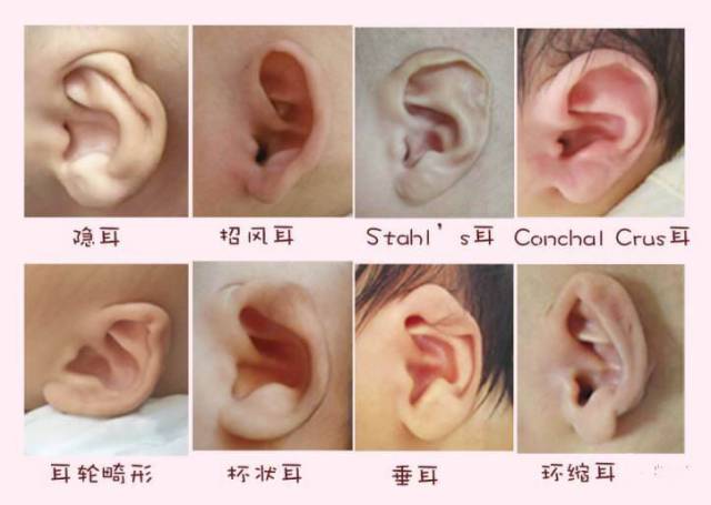 耳廓畸形修复的方法有哪些